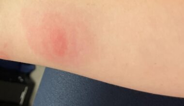 Ways to Stay Ahead of Tick Season | Local News