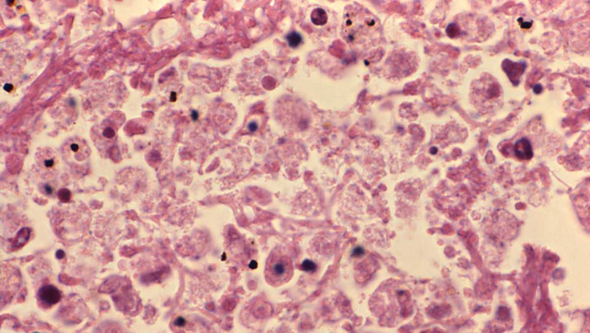 Patients at Pittsburgh VA Medical Center test positive for Legionella