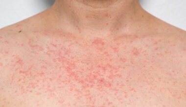 Second measles case in Erie County