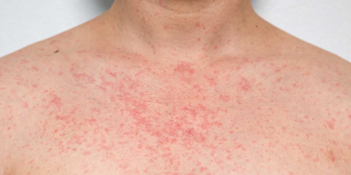 Second measles case in Erie County