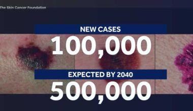 Pennsylvania woman shares melanoma journey as cases rise across the U.S.