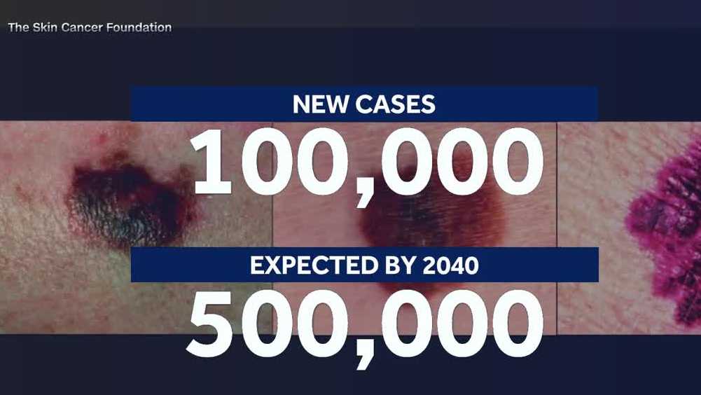Pennsylvania woman shares melanoma journey as cases rise across the U.S.