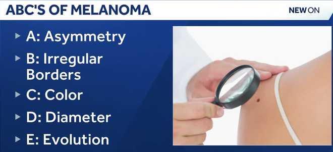 Melanoma, the fifth most common cancer in the U.S., is projected to become the second most common within 15 years, as cases continue to rise across the country. melanoma, the fifth most common cancer in the u.s., is projected to become the second most common within 15 years, as cases continue to rise across the country.