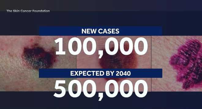 Melanoma, the fifth most common cancer in the U.S., is projected to become the second most common within 15 years, as cases continue to rise across the country. melanoma, the fifth most common cancer in the u.s., is projected to become the second most common within 15 years, as cases continue to rise across the country.