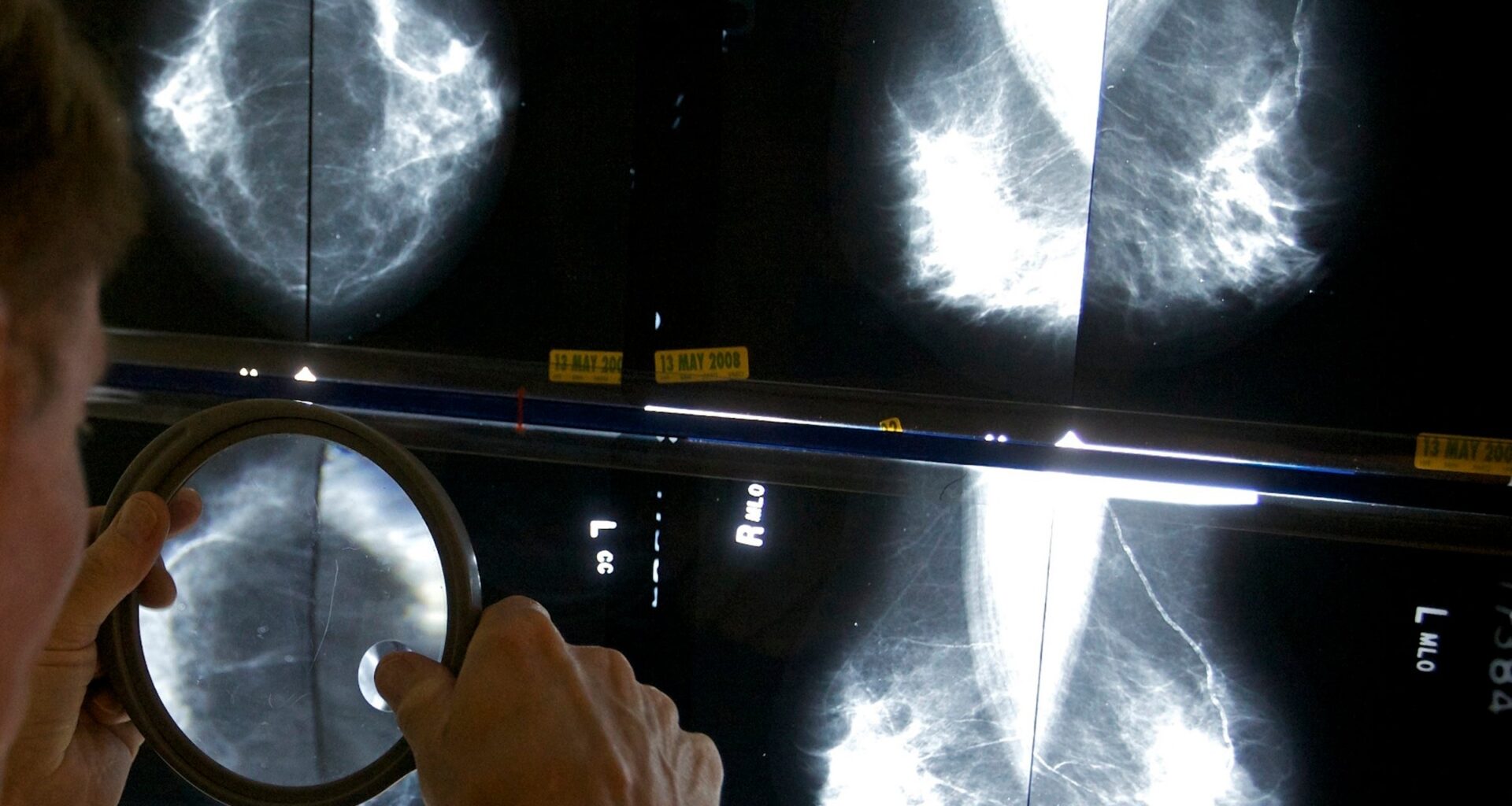 Penn study links GLP-1 use to lower breast cancer risk