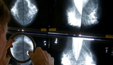 Penn study links GLP-1 use to lower breast cancer risk