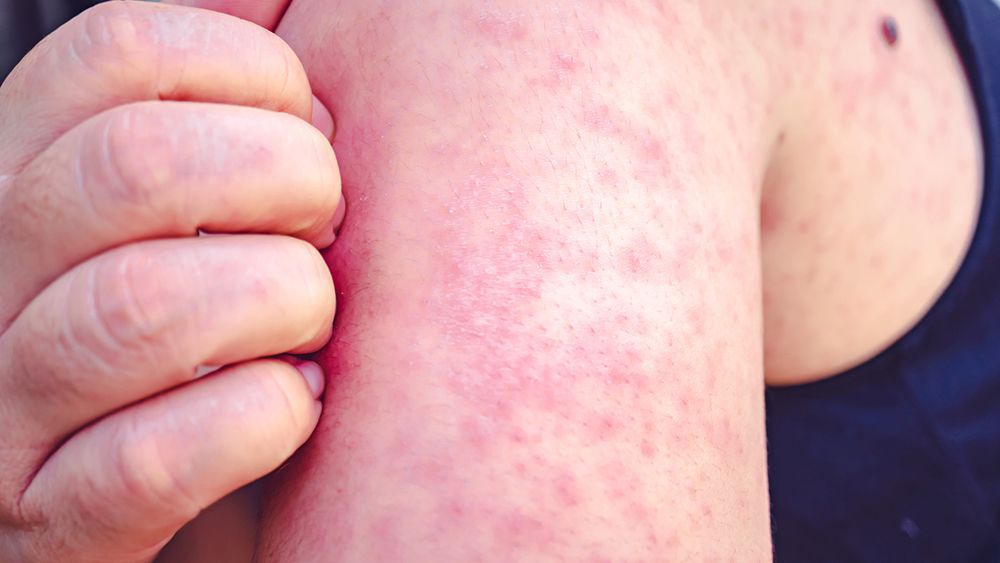 measles