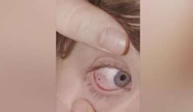 Tick found on Pennsylvania boy's eye: "Check everywhere"
