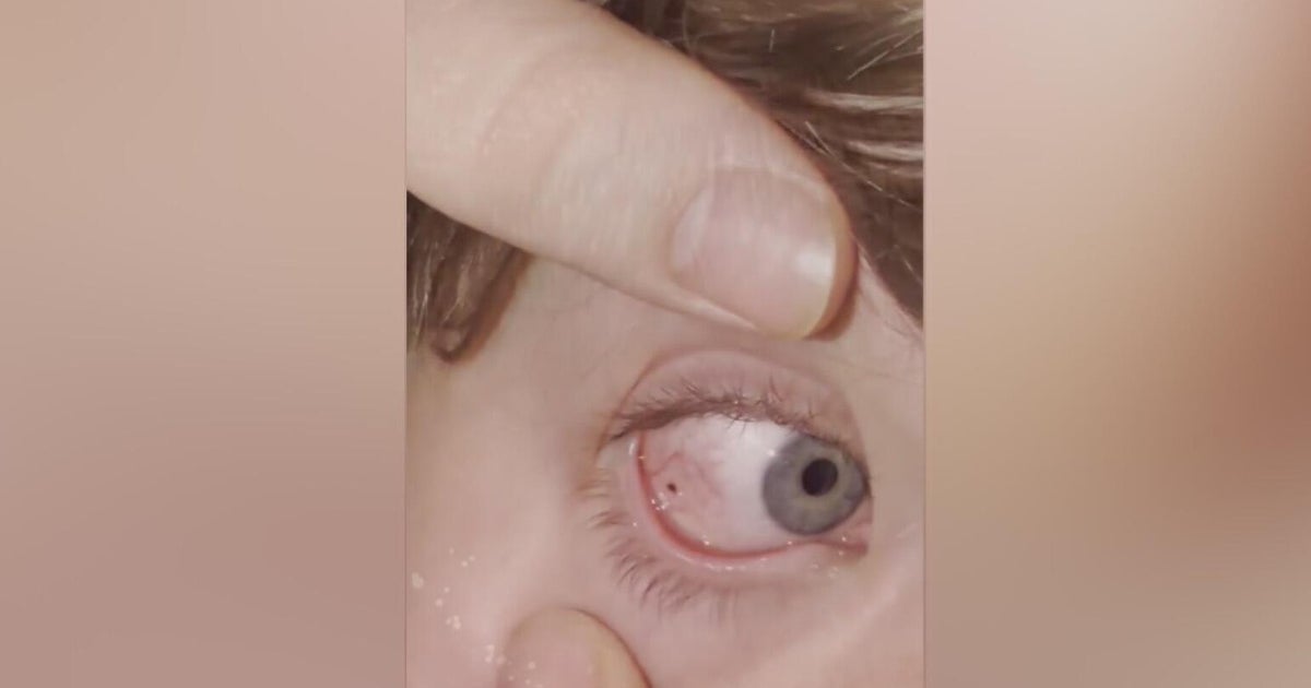 Tick found on Pennsylvania boy's eye: "Check everywhere"
