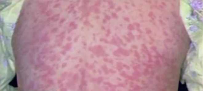 The Pennsylvania Department of Health is warning about potential measles exposure at Philadelphia International Airport on July 4. the pennsylvania department of health is warning about potential measles exposure at philadelphia international airport on july 4.