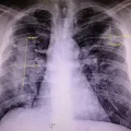 an x-ray of lungs showing scarring