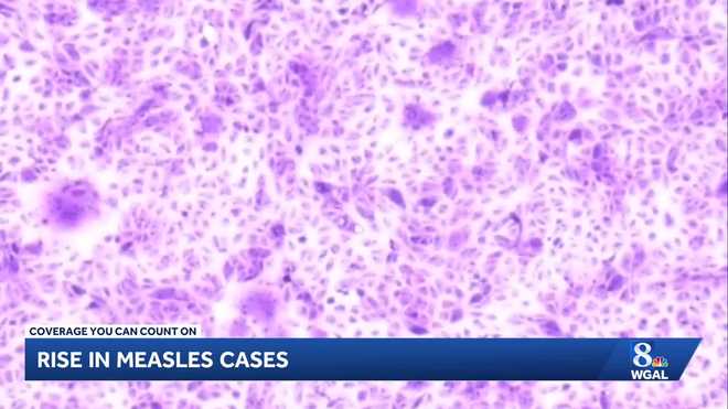 Pennsylvania has reported 101 measles cases, with Lancaster County accounting for 52 of them, as health officials warn the outbreak is ongoing and emphasize the need for vaccinations. Pennsylvania has reported 101 measles cases, with Lancaster County accounting for 52 of them, as health officials warn the outbreak is ongoing and emphasize the need for vaccinations.