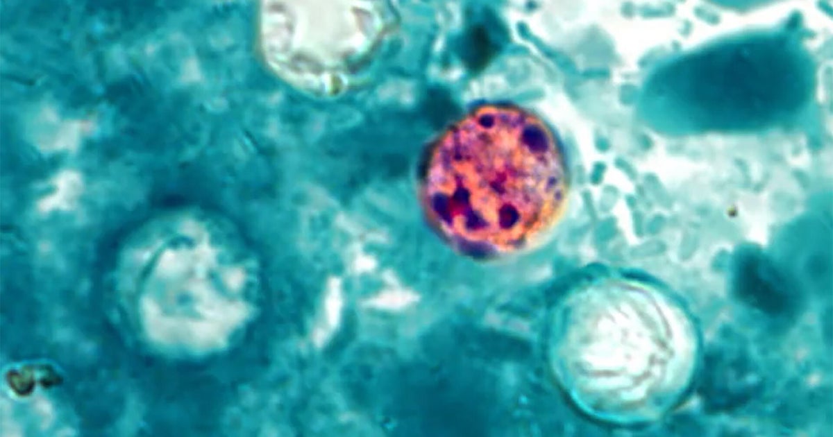 Allegheny County reports 35 cyclosporiasis cases, 2 hospitalizations as officials probe connection to outbreak