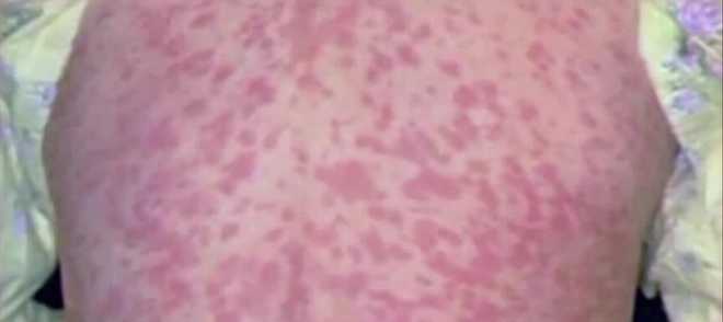 Pennsylvania has reported 101 measles cases, with Lancaster County accounting for 52 of them, as health officials warn the outbreak is ongoing and emphasize the need for vaccinations. Pennsylvania has reported 101 measles cases, with Lancaster County accounting for 52 of them, as health officials warn the outbreak is ongoing and emphasize the need for vaccinations.