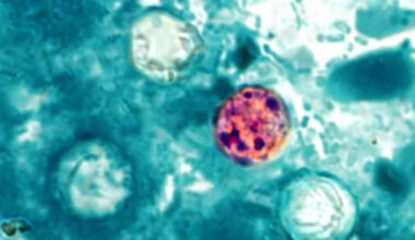 Pennsylvania added to cyclosporiasis outbreak list with at least 2 dozen cases