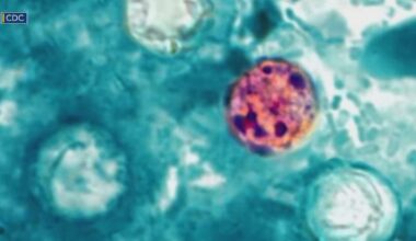 Allegheny County Health Department reports 11 cases of Cyclosporiasis