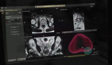 Pittsburgh-area lawmakers and organizations aim to raise awareness about prostate cancer risks