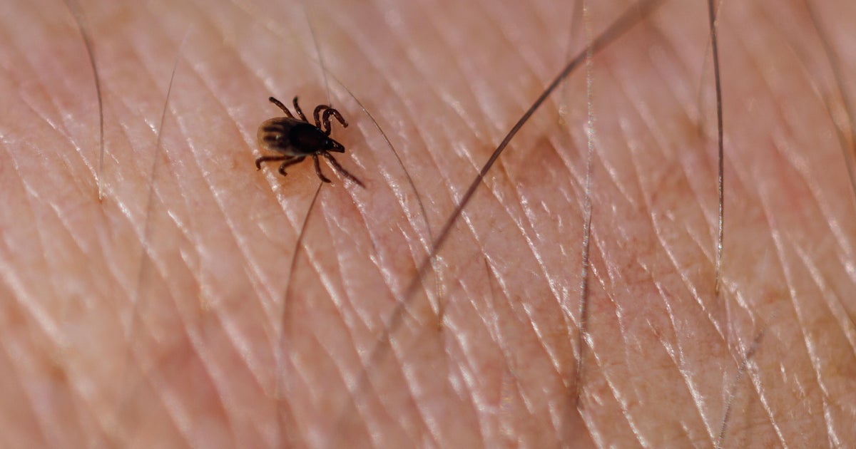 Tick season in Pennsylvania and N.J. comes with new concern over rare but dangerous tick-borne illness