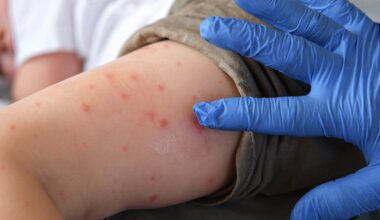 Pennsylvania measles deaths reported in unvaccinated Lancaster residents