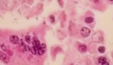 Infant reported among 2 measles-associated deaths in Pennsylvania: DOH