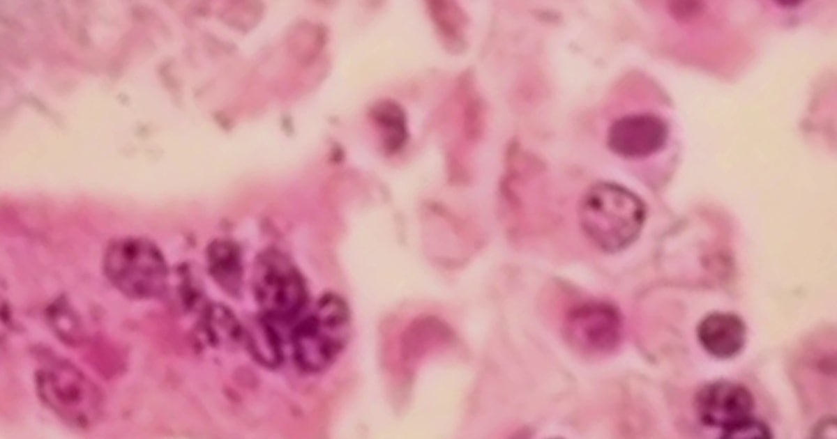 Infant reported among 2 measles-associated deaths in Pennsylvania: DOH