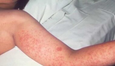 Pittsburgh doctor warns parents as measles cases rise in Pennsylvania