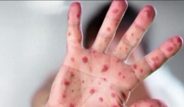 Gov. Shapiro and RFK Jr. clash on measles outbreak as cases rise in Pennsylvania – NBC10 Philadelphia