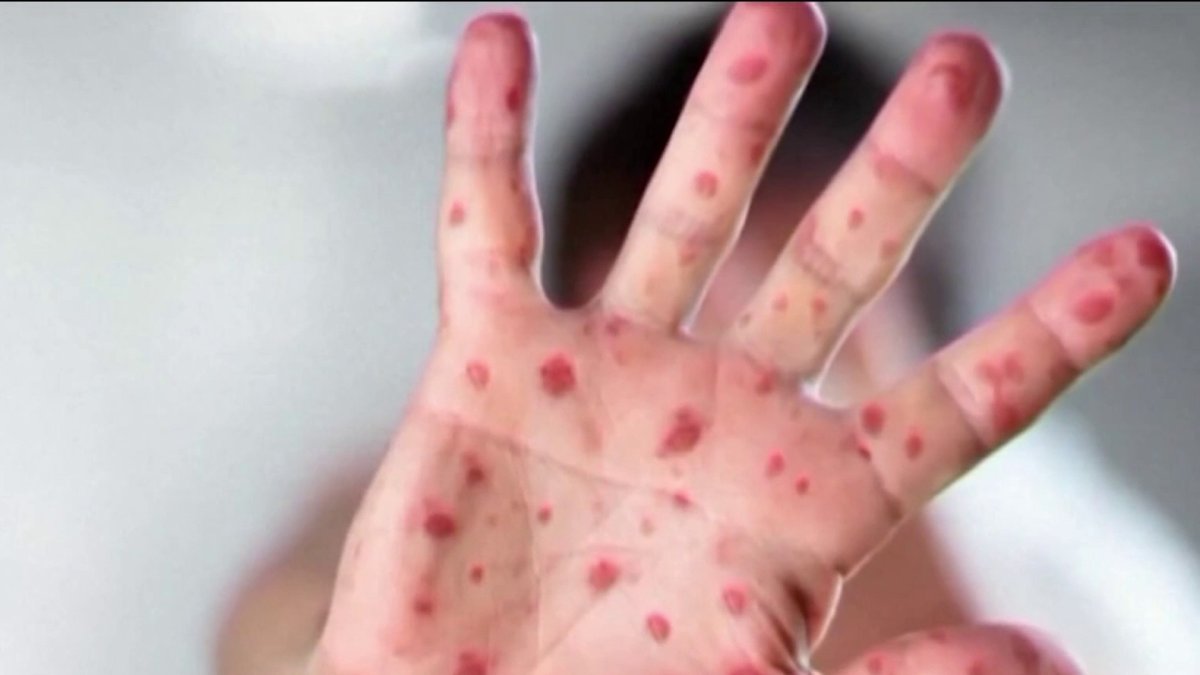 Gov. Shapiro and RFK Jr. clash on measles outbreak as cases rise in Pennsylvania – NBC10 Philadelphia