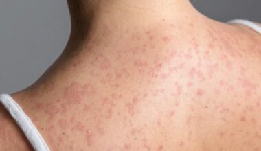It's a "matter of time" before Pittsburgh sees measles cases, doctor says