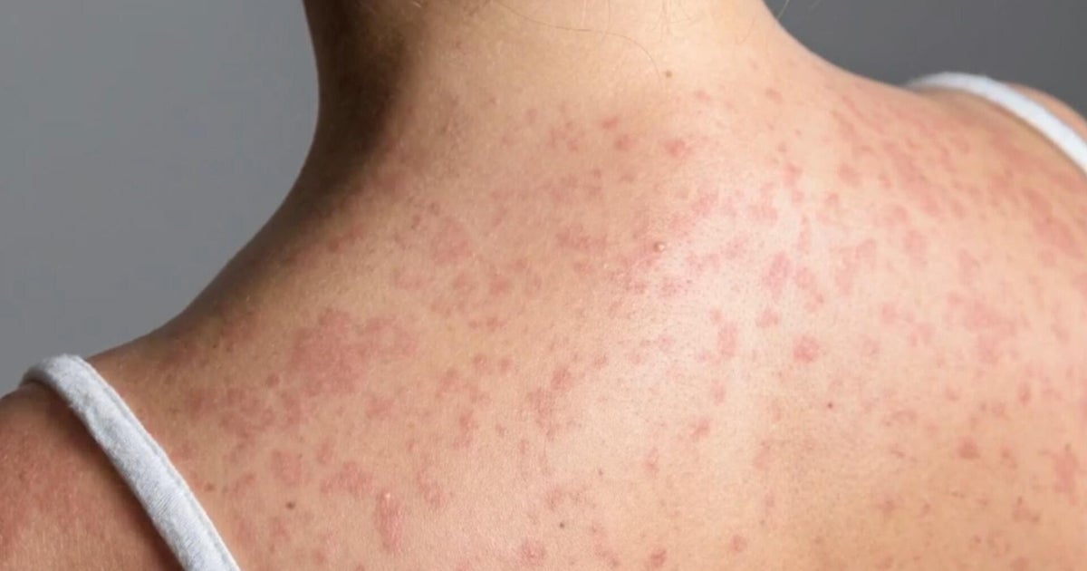 It's a "matter of time" before Pittsburgh sees measles cases, doctor says