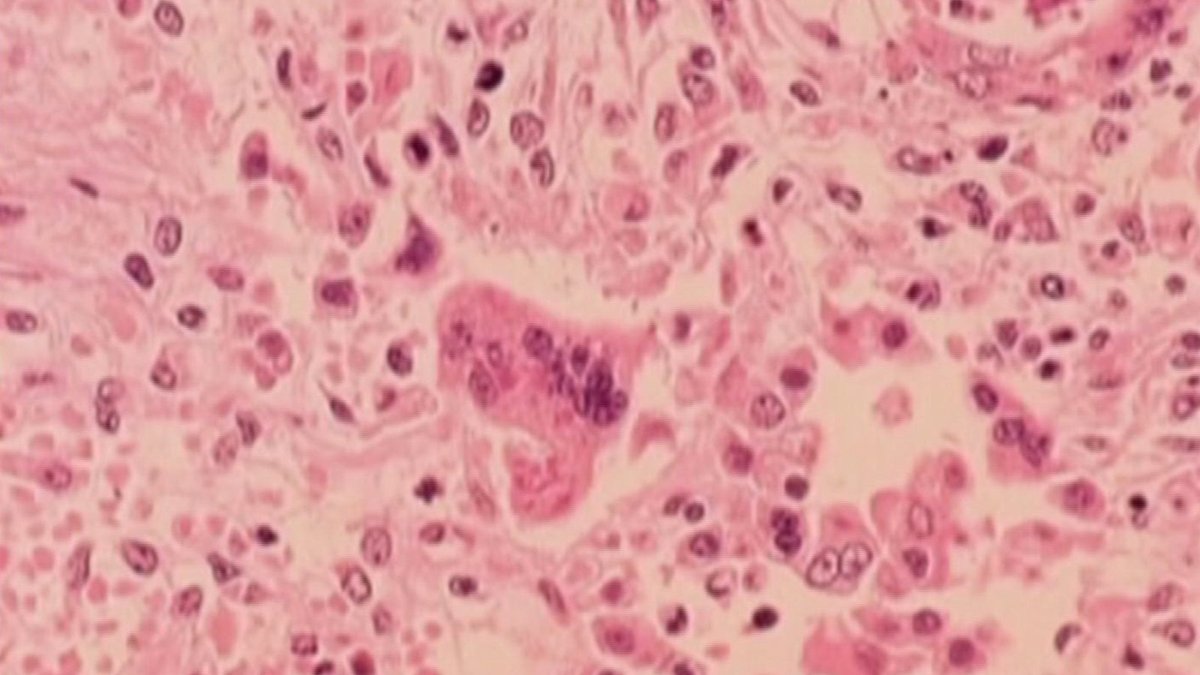 Pennsylvania measles outbreak grows to 460 cases – NBC10 Philadelphia