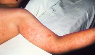 Local doctor shares what you need to know following reported case of measles in Pittsburgh area