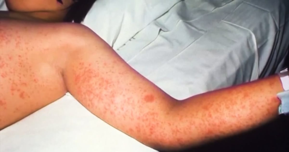 Local doctor shares what you need to know following reported case of measles in Pittsburgh area