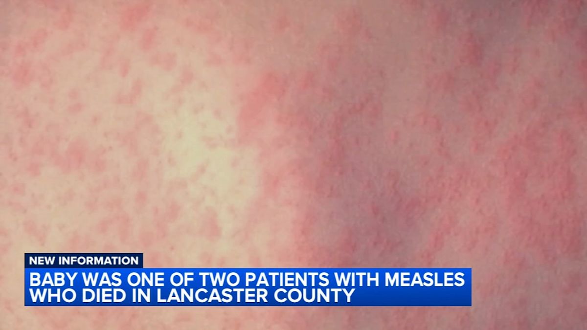 Baby among 2 unvaccinated measles deaths in Lancaster County, Pennsylvania officials say