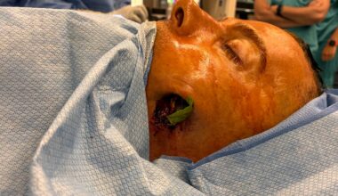 Tree branch impales South Jersey man through face and into brain in freak accident: "It's mind-boggling"
