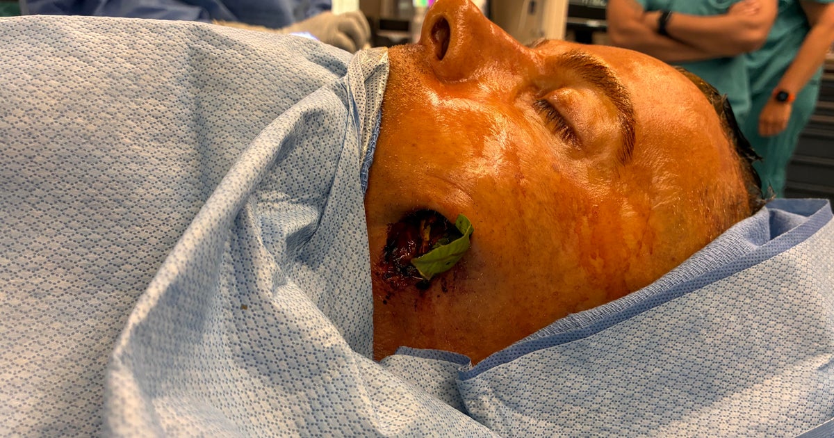 Tree branch impales South Jersey man through face and into brain in freak accident: "It's mind-boggling"