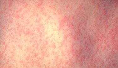 Illinois measles case, deaths in Pennsylvania prompt vaccination warning