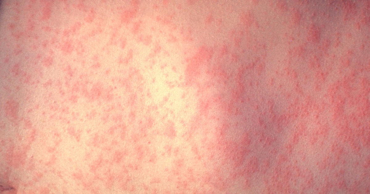 Illinois measles case, deaths in Pennsylvania prompt vaccination warning