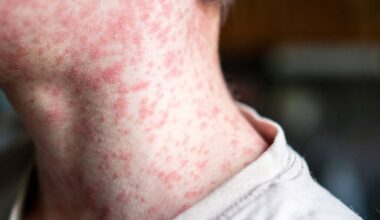 UPMC confirms 1st positive measles case in Allegheny County