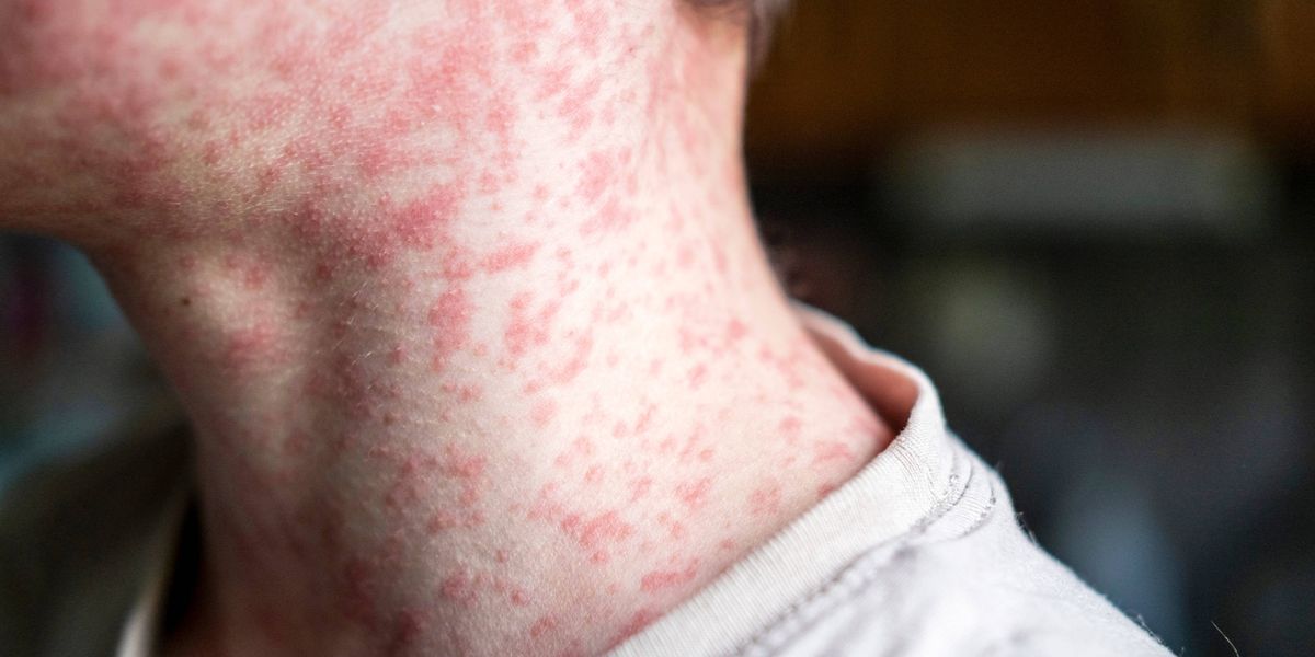 UPMC confirms 1st positive measles case in Allegheny County
