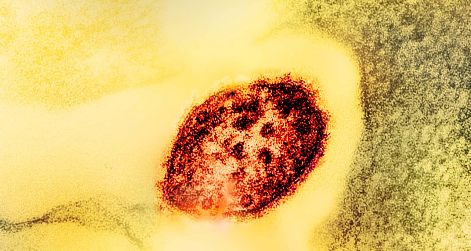 2 Measles-related Deaths Reported in Pennsylvania