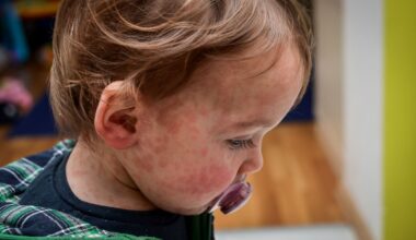 A toddler boy with a red measles rash on his face.