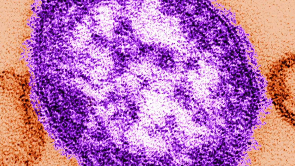 Adult woman dies of measles complications in growing Pennsylvania outbreak