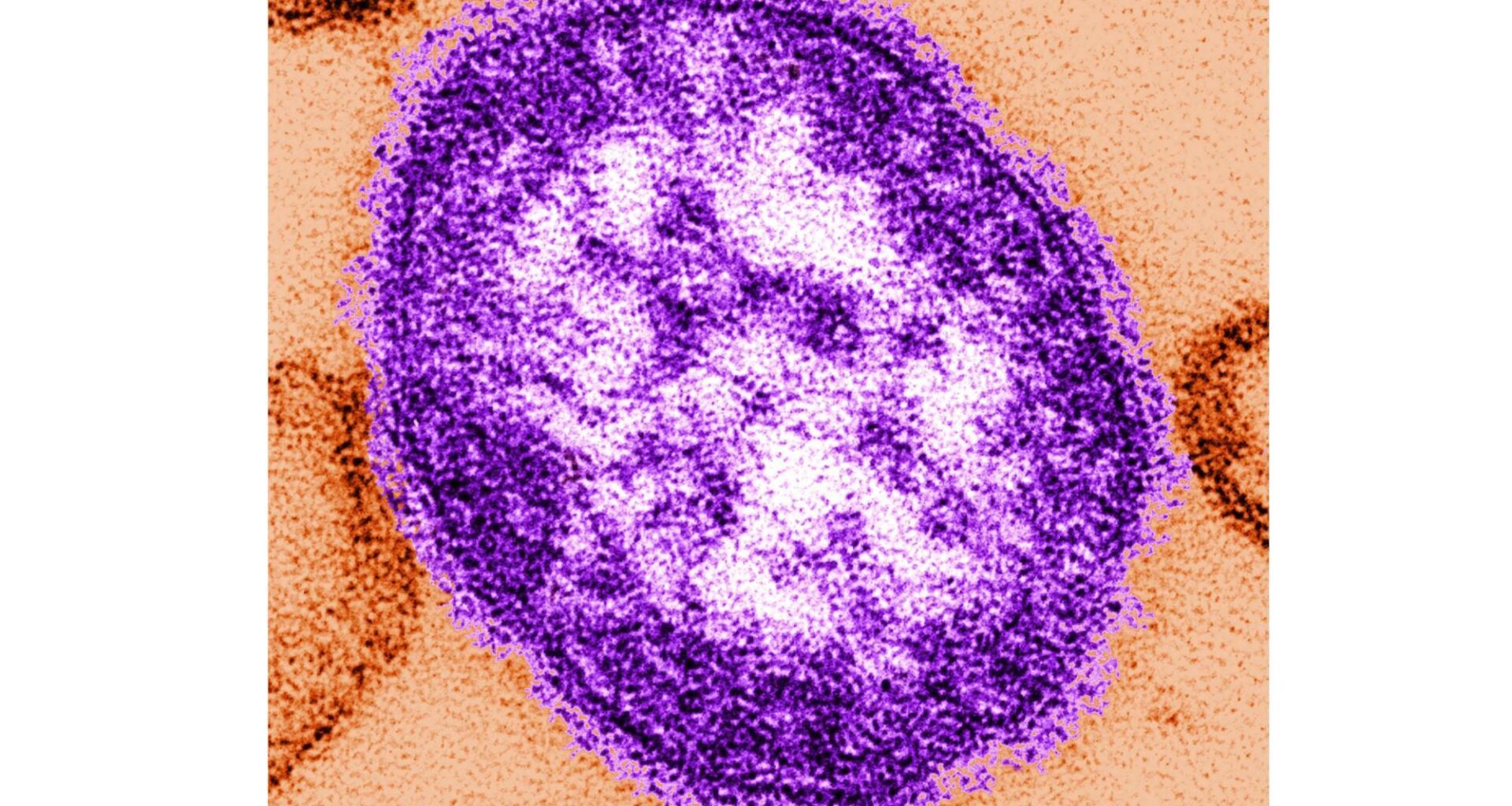 Pennsylvania officials report state's 3rd death involving measles