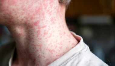 Measles outbreak grows in Pennsylvania with 43 new cases – NBC10 Philadelphia