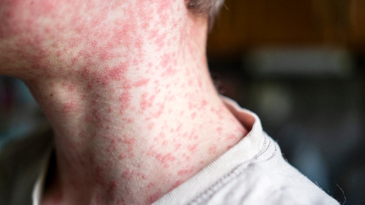 Measles outbreak grows in Pennsylvania with 43 new cases – NBC10 Philadelphia