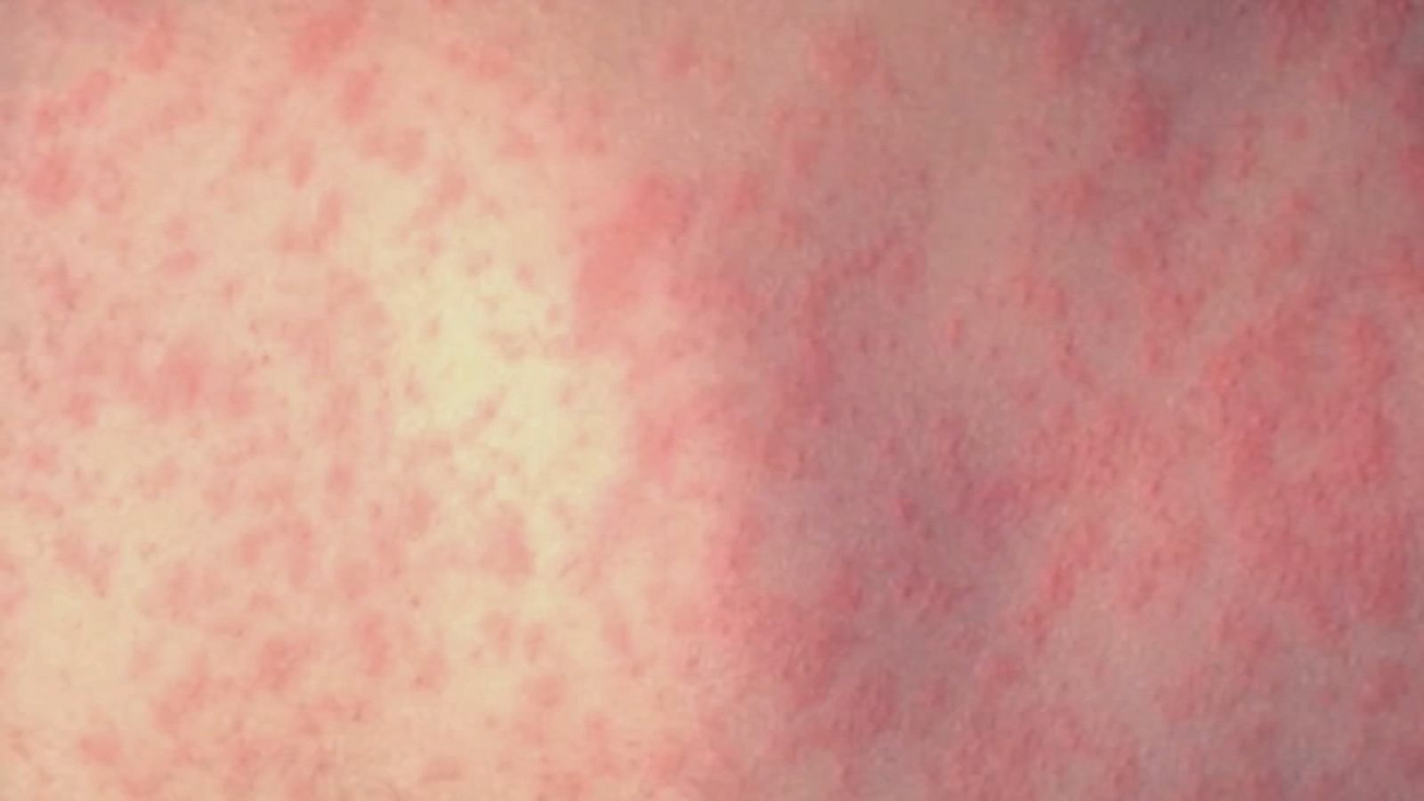 Pennsylvania surpasses 900 measles cases, with 13 new confirmed infections, as outbreak continues to spread: Officials