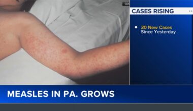Pennsylvania's measles outbreak grows to 624 cases