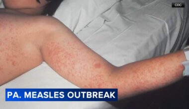 Health officials report 43 new measles cases in Pennsylvania since Monday; state total now topping 800