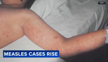 Measles cases rise as CDC lists first measles-related death; Philly doctor recalls 1991 outbreak